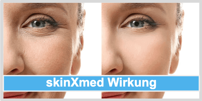Vorher Nachher Bild einer Frau skinXmed Wirkung
