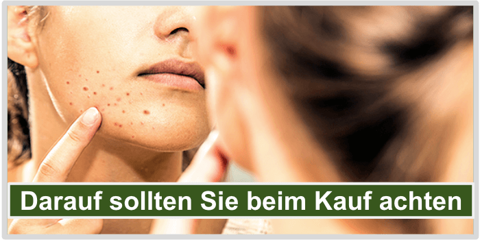 Ein Mädchen mit Akne Kauf achten Bild